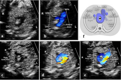 Short Axis Views Of A Fetus At 22 Weeks With Double Aortic Arch And Download Scientific Diagram