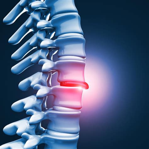 Understanding Your Treatment Options For A Herniated Disc Advanced
