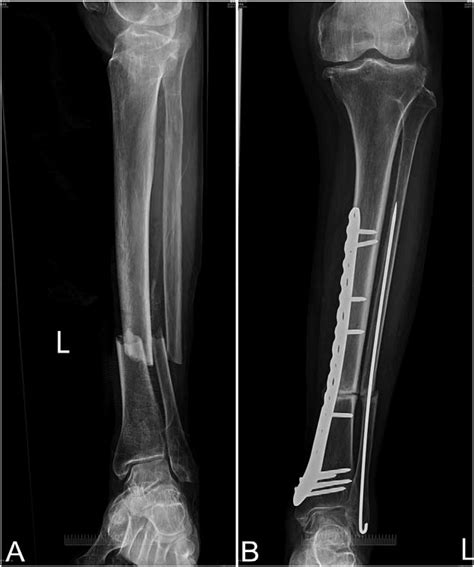A The Radiograph Of Left Tibia And Fibula Shaft Open Fracture Type
