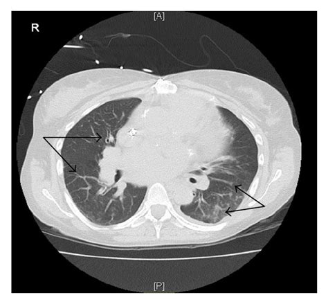 Ct Scan Of The Chest Showing Bilateral Lungs Ground Glass And