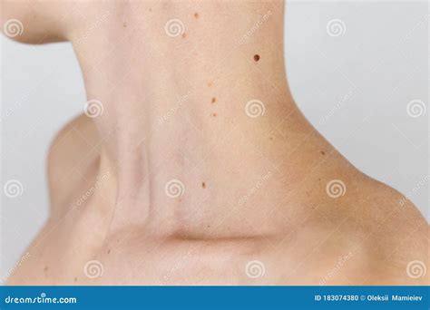 Neck Shoulder And Collarbone Of A Young Girl With A Lot Of Moles