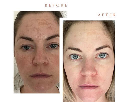 Melasma Treatment Guide Best Melasma Treatment Australia Qr8 Mediskin