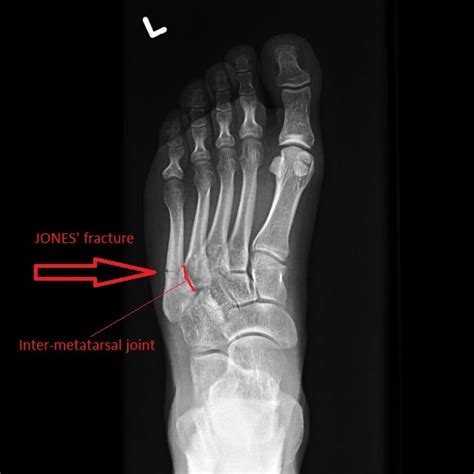 Diagnose On Sight Fifth Metatarsal Fractures Med Tac International Corp
