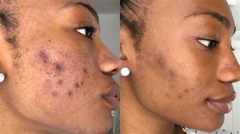 Clearing Up Acne Scarring And Hyperpigmentation Youtube