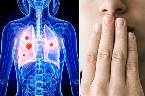 Are There Early Signs Of Lung Cancer Lung Cancer Signs How Do You