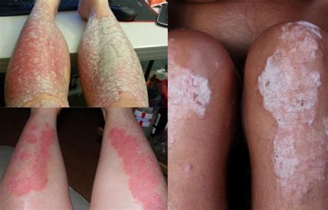 Psoriasis On Legs Causes Symptoms And Treatment Psoriasis Expert