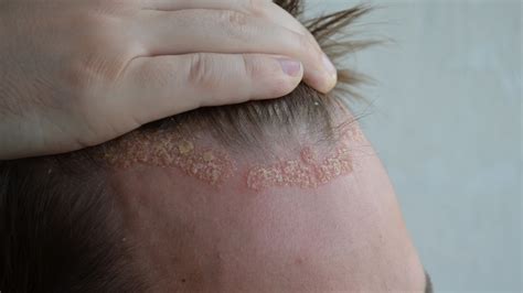 Scalp Eczema Fleur Scalp Care