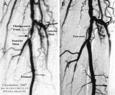 Mercy Angiography Procedures And Treatments Interventional Radiology