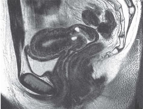 Diseases Of The Uterus Radiology Key