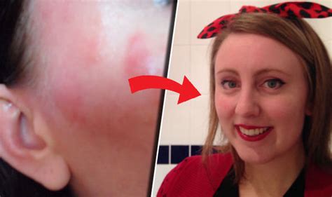 Eczema Treatment Woman Cured Her Skin By Bathing In Epsom Salts