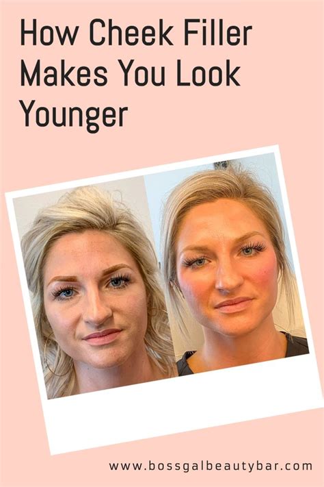How Cheek Filler Makes You Look Younger In 2021 Cheek Fillers Beauty