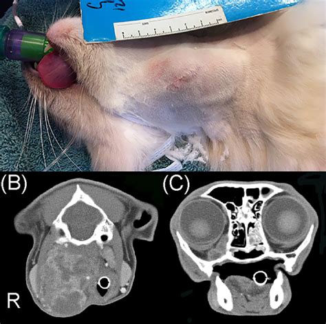 The Right Medial Retropharyngeal Lymph Node Was Enlarged A And On