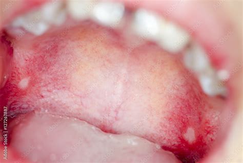 Macro Close Up And Depth Of Field Dof Infection In Open Mouth