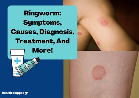 Ringworm Tinea Dermatophytosis Causes Symptoms Signs My Xxx Hot Girl