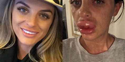 when botox and lip fillers go wrong 20 pics club giggle