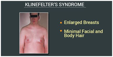 Klinefelter Syndrome Pictures Symptoms Causes Treatme Vrogue Co