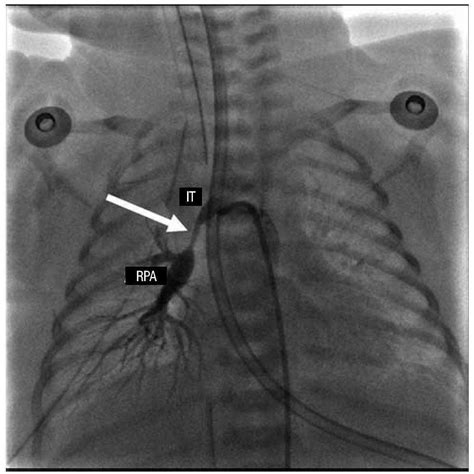 Disconnection Of The Right Pulmonary Artery With Bilateral Ductus