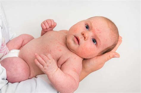 Petechiae In Infants Symptoms Causes And Treatment