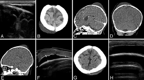 Subgaleal Hematoma In Adults