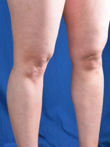 Patient 1334 Legs Liposuction Before And After Photos Denver Co