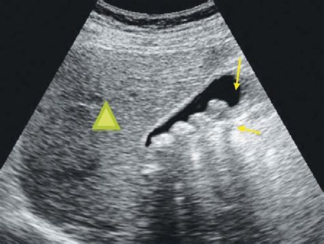 Ultrasound Of The Right Upper Quadrant In A Patient With Ruq Abdominal