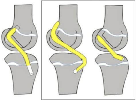 Cosm Acl Reconstruction In Children