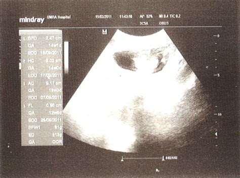 Masa scan ni, boleh nampak dah kepala bayi, tulang belakang, tangan, kaki, denyutan jantung. My Pregnancy Day and Progress...: Gambar scan babies...