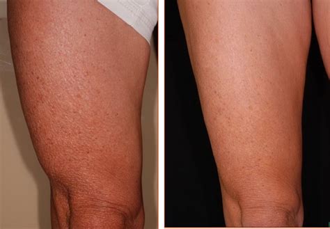 Non Surgical Fat Reduction And Skin Tightening Procedures Thermage And Exilis Increase At