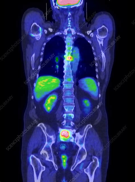 Secondary Cancer Pet Scan Stock Image M1340701 Science Photo