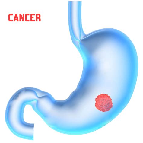 Stomach Cancer Treatment Coimbatore Stomach Cancer Hospital In India