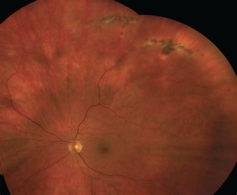 Lattice Degeneration Of Retina Synergy Eye Care