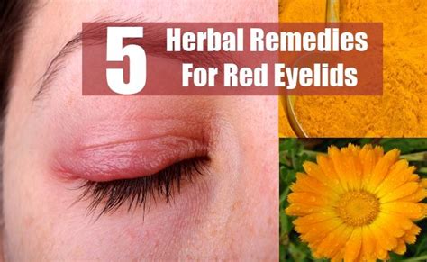 Top Five Herbal Remedies For Red Eyelids Herbal Remedies Natural