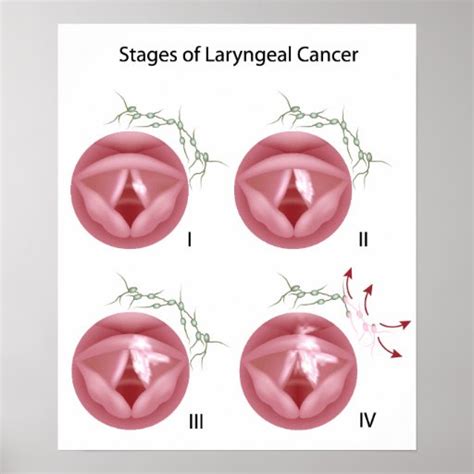 Laryngeal Cancer Stages Poster Zazzle