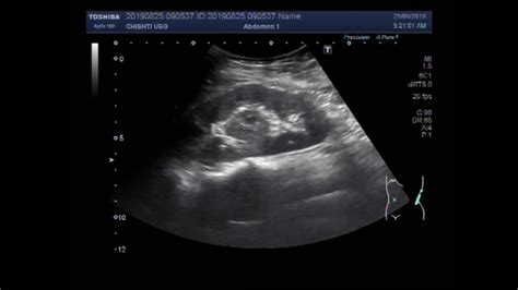 Ultrasound Video Showing A Renal Mass In Renal Pelvis Youtube