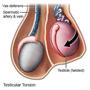 Testicular Torsion What You Need To Know