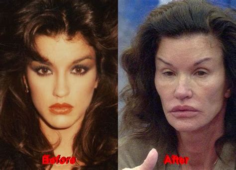 Janice Dickinson Plastic Surgery Before After Facelift Before And After In 2019 Botched