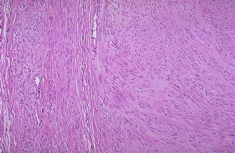 Looking for online definition of myometrium in the medical dictionary? of a benign leiomyoma