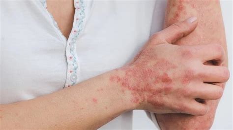 What Is The Best Treatment For Psoriasis Homeopathic Allopathic Or