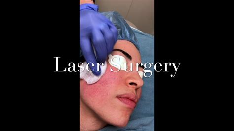 Acne Scar Surgery Youtube