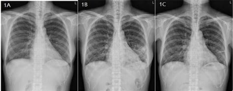 Serial Chest Radiographs Of The Patient The Baseline Chest Radiograph
