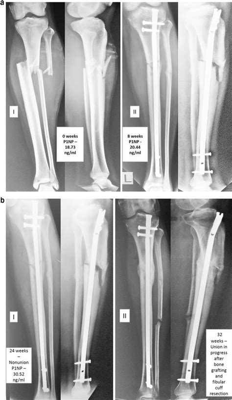 A 1 And 2 Plain Radiographs Ap And Lateral Of Fracture Of The