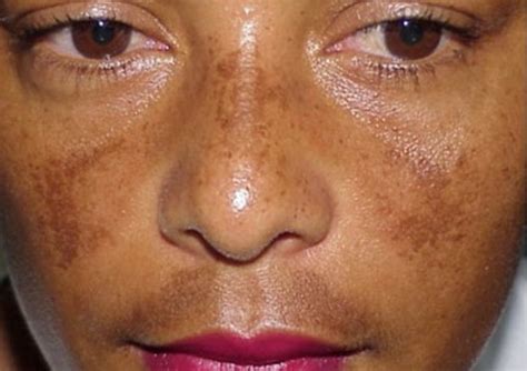 Melasma Vs Hyperpigmentation B Skin Legacy
