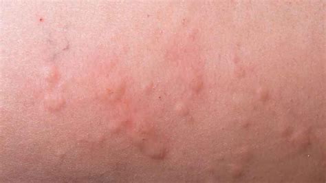 When To Worry About A Rash In Adults Page 8 Of 15 Healthella