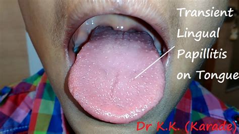 Transient Eruptive Lingual Papillitis On Tongue After