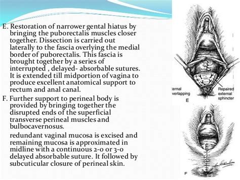Perineal Lacerations In Absorbable Suture Perineal Tear Perineum
