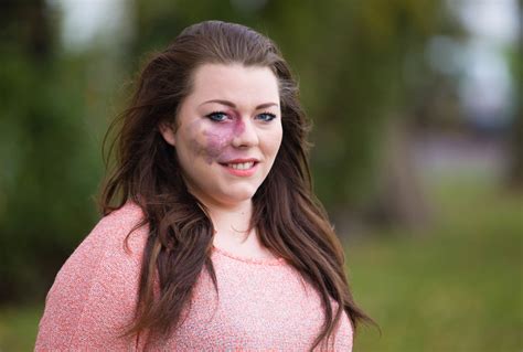 Woman Stops Concealing Port Wine Stain Birthmark On Face With Makeup