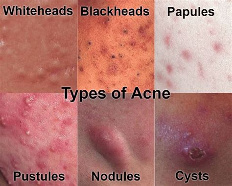 Acne • Repair And Rejuvenate Acne Skin • Nascent Skin Clinic