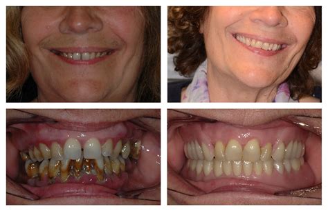 Dental Dentures Surrey Complete And Partial Dentures For Missing Teeth