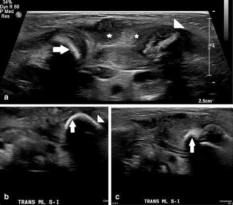 Ultrasound Of The Sternoclavicular Joint In The Boy At 12 Days Old A