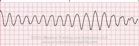Ventricular Tachycardia Polymorphic EKG Interpretation With Rhythm Strip